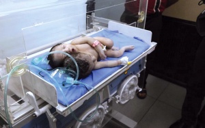 В Ираке родился ребенок с двумя головами 
