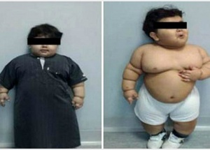 Двухлетний саудовец стал самым молодым человеком в мире, перенесшим операцию по уменьшению желудка